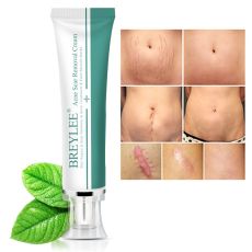 Removal Scar Cream Face Pimples Scar Stretch Marks Removal Acne Treatment Whitening Moisturizing