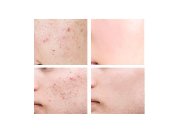 BREYLEE Acne Scar Removal Gel Fade Acne Marks Spots Remove Skin