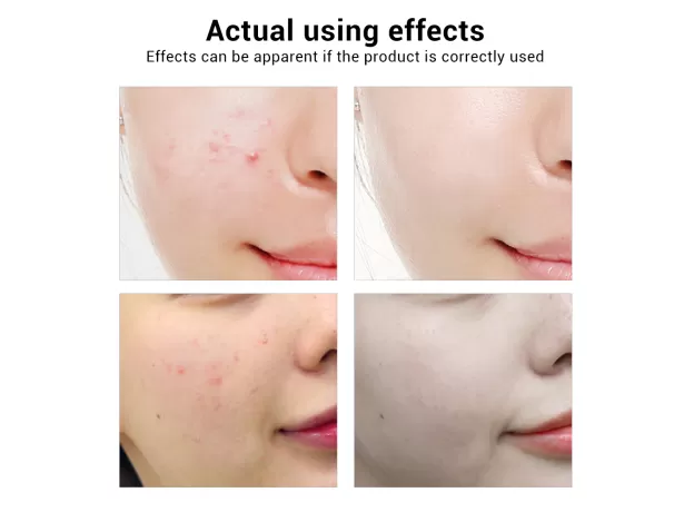 BREYLEE ACNE TREATMENT SERUM & MASK – ANTI ACNE, PIMPLE SCAR REMOVER & WHITENING CARE
