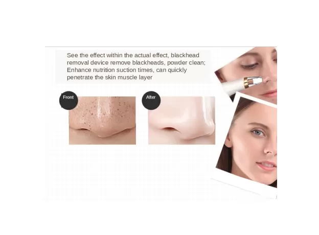 BLACKHEAD REMOVER ACNE TREATMENT VACUUM PORE CLEANER