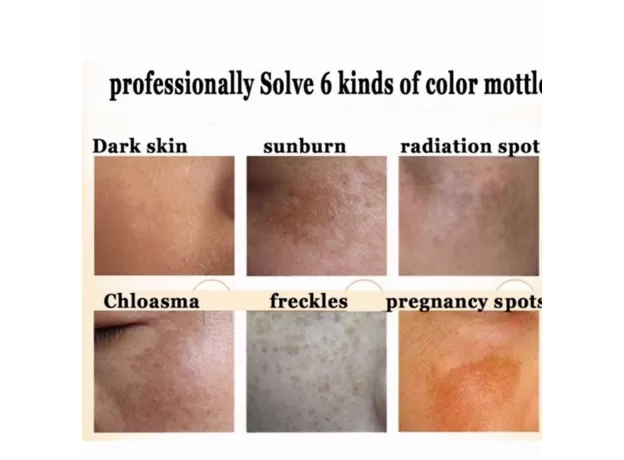 2PCS/SET FACE WHITENING CREAM BRIGHTENING FRECKLE DARK SPOT CORRECTOR REMOVAL FADE